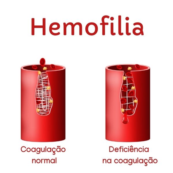 Ilustração de como ocorre a coagulação em uma pessoa com hemofilia.