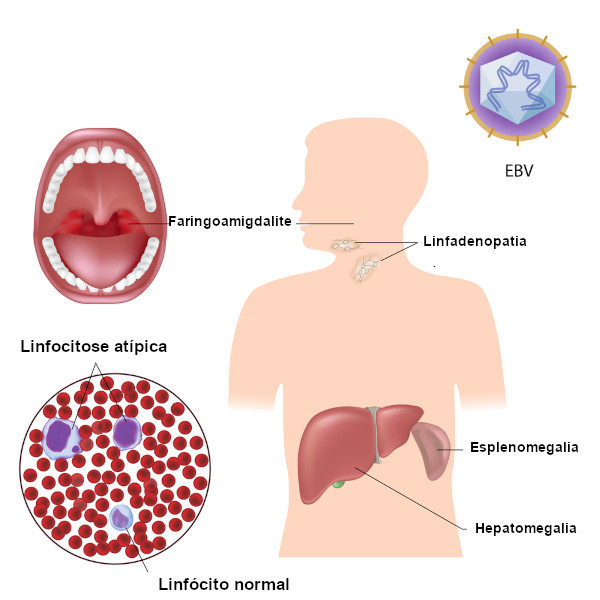 Ilustração demonstra sintomas da mononucleose.
