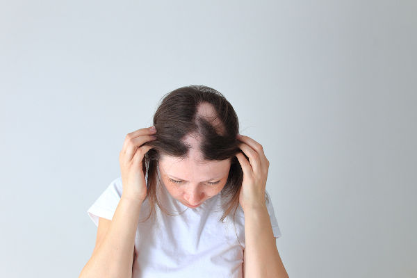 Mulher com falhas circulares na região dos cabelos em decorrência da alopecia areata.
