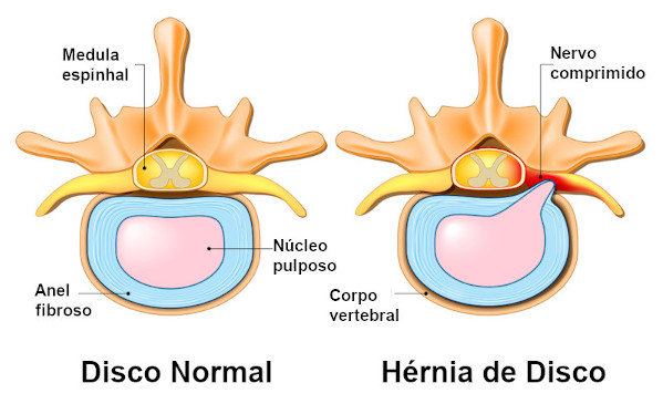 Ilustração indicando como é um disco normal e como é a hérnia de disco.