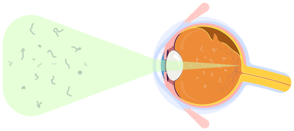 Representação do surgimento de moscas volantes no olho humano.