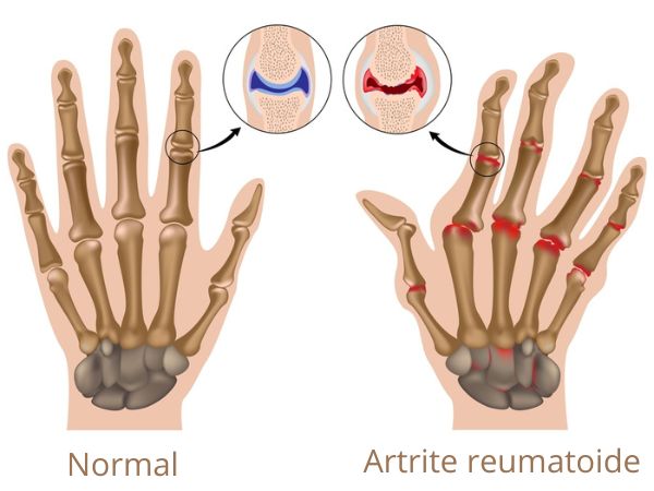 Representação pictográfica de uma mão saudável e outra mão acometida por artrite reumatoide