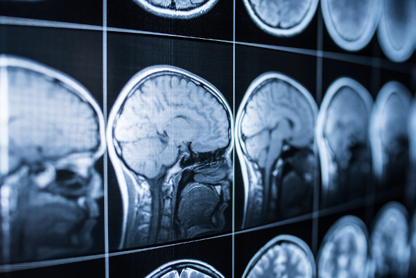 Resultado de uma radiografia da cabeça de um ser humano, mostrando seu cérebro.