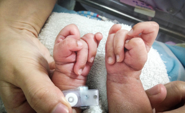 Criança com sobreposição dos dedos das mãos, um dos sintomas da síndrome de Edwards (trissomia do cromossomo 18).