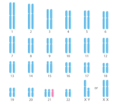 Imagem mostrando a trissomia do cromossomo 21, que caracteriza a síndrome de Down.