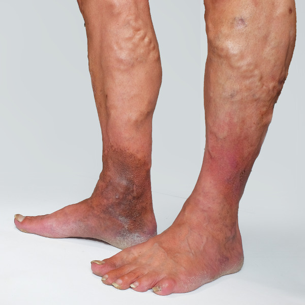 Dermatite de estase em duas pernas com varizes.