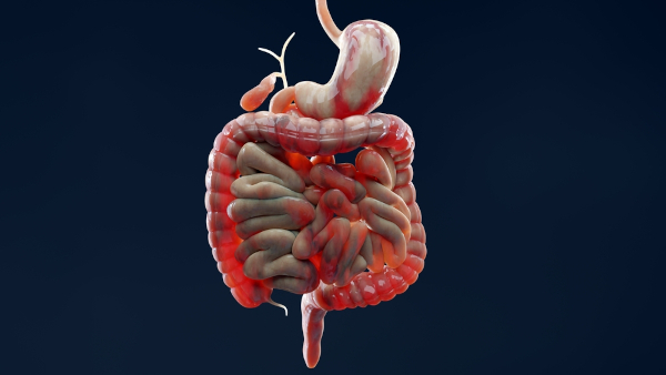 Representação gráfica da mucosa do trato gastrointestinal com doença de Crohn.