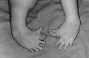 Malformação congênita dos pés, um dos efeitos do uso de talidomida sobre fetos