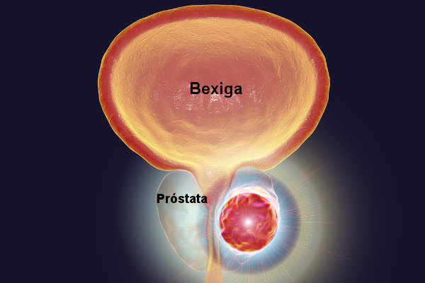 Na figura acima, temos uma representação de um tumor na próstata. A formação de tumor nesse local pode impedir a passagem da urina.